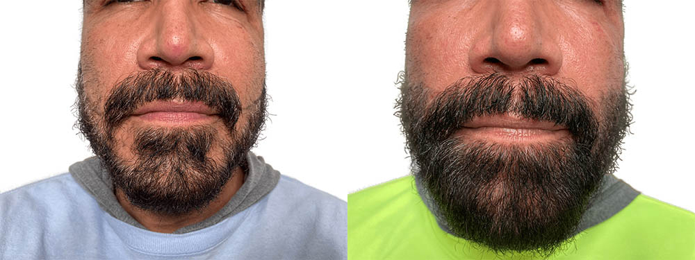 Hair Transplants Before & After Patient #640
