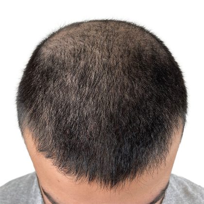 Hair Transplants Before & After Patient #1152