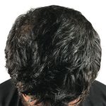 Hair Transplants Before & After Patient #1152