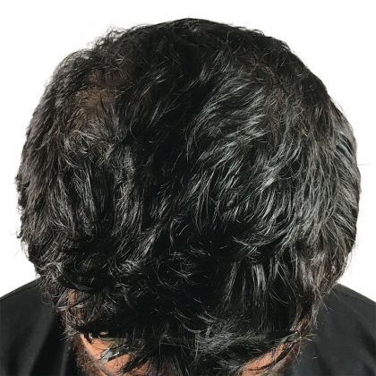 Hair Transplants Before & After Patient #1152