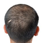 Hair Transplants Before & After Patient #1152