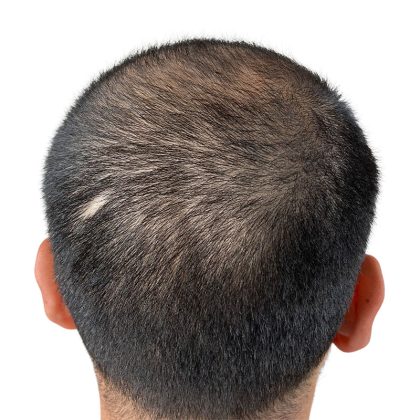 Hair Transplants Before & After Patient #1152