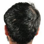 Hair Transplants Before & After Patient #1152