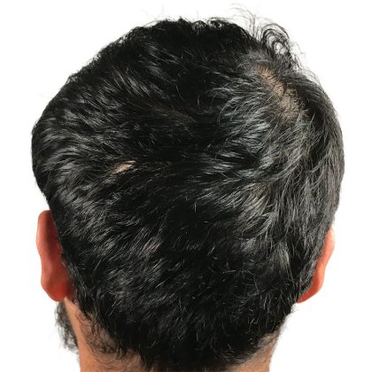 Hair Transplants Before & After Patient #1152