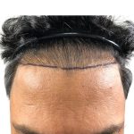 Hair Transplants Before & After Patient #1153
