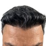 Hair Transplants Before & After Patient #1153