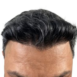 Hair Transplants Before & After Patient #1153