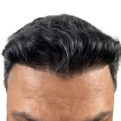 Hair Transplants Before & After Patient #1153