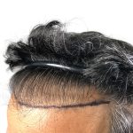 Hair Transplants Before & After Patient #1153