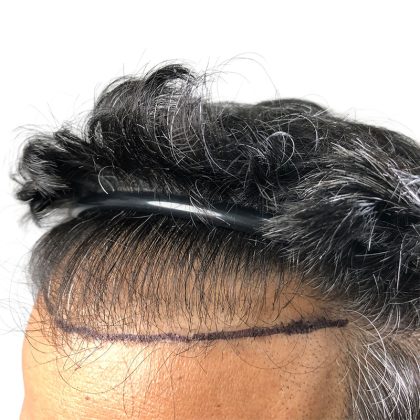 Hair Transplants Before & After Patient #1153