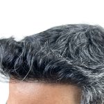 Hair Transplants Before & After Patient #1153
