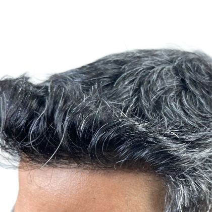 Hair Transplants Before & After Patient #1153