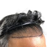 Hair Transplants Before & After Patient #1153