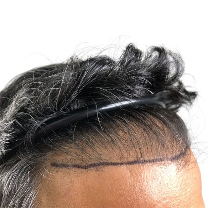 Hair Transplants Before & After Patient #1153