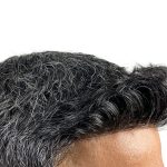 Hair Transplants Before & After Patient #1153
