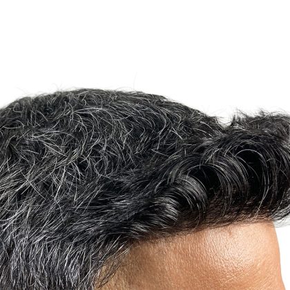 Hair Transplants Before & After Patient #1153