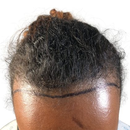 Hair Transplants Before & After Patient #1154