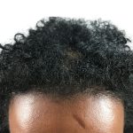 Hair Transplants Before & After Patient #1154