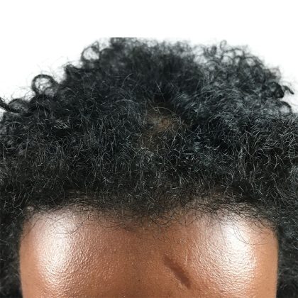 Hair Transplants Before & After Patient #1154