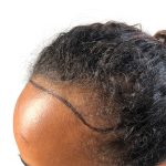 Hair Transplants Before & After Patient #1154