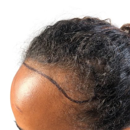 Hair Transplants Before & After Patient #1154
