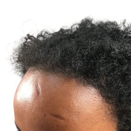 Hair Transplants Before & After Patient #1154