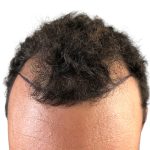 Hair Transplants Before & After Patient #1175