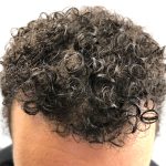 Hair Transplants Before & After Patient #1175