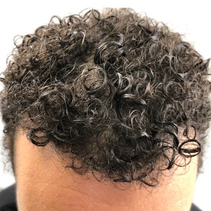 Hair Transplants Before & After Patient #1175