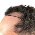 Hair Transplants Before & After Patient #1175