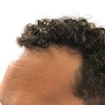 Hair Transplants Before & After Patient #1175