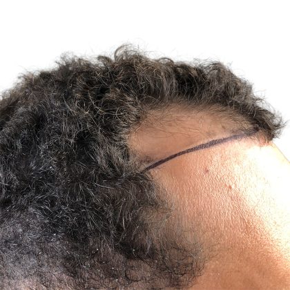 Hair Transplants Before & After Patient #1175