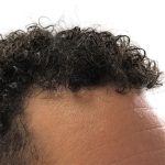 Hair Transplants Before & After Patient #1175