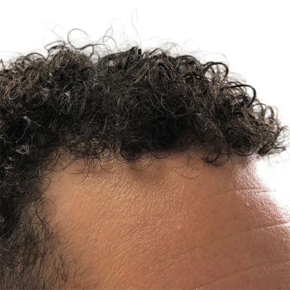 Hair Transplants Before & After Patient #1175