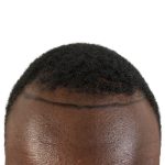 Hair Transplants Before & After Patient #1176
