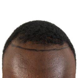 Hair Transplants Before & After Patient #1176