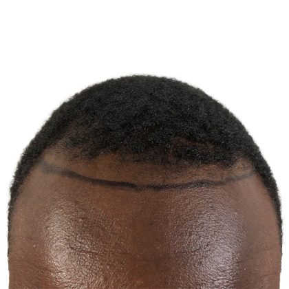 Hair Transplants Before & After Patient #1176