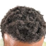 Hair Transplants Before & After Patient #1176
