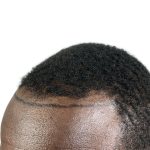 Hair Transplants Before & After Patient #1176