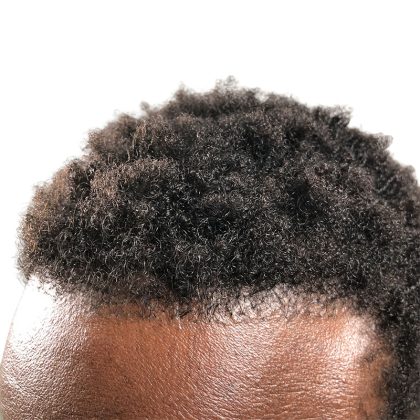 Hair Transplants Before & After Patient #1176
