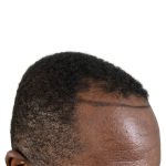 Hair Transplants Before & After Patient #1176