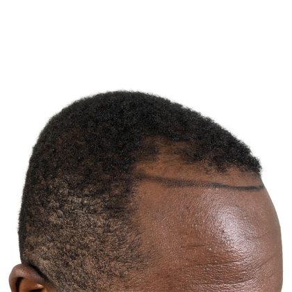 Hair Transplants Before & After Patient #1176