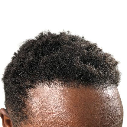 Hair Transplants Before & After Patient #1176