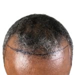 Hair Transplants Before & After Patient #1177