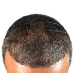 Hair Transplants Before & After Patient #1177