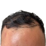 Hair Transplants Before & After Patient #1178