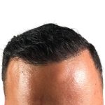 Hair Transplants Before & After Patient #1178