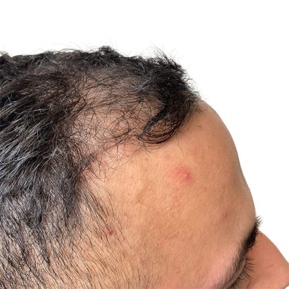 Hair Transplants Before & After Patient #1178