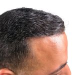 Hair Transplants Before & After Patient #1178