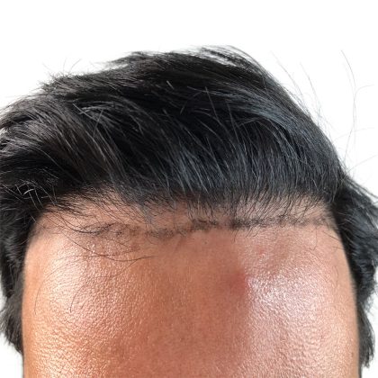 Hair Transplants Before & After Patient #1376